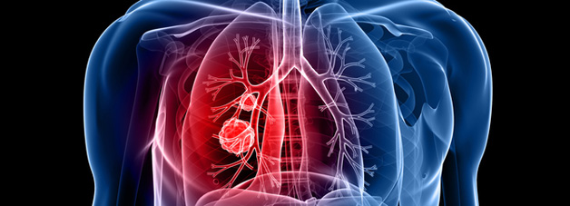 More than 44,000 people are diagnosed with lung cancer each year in the UK